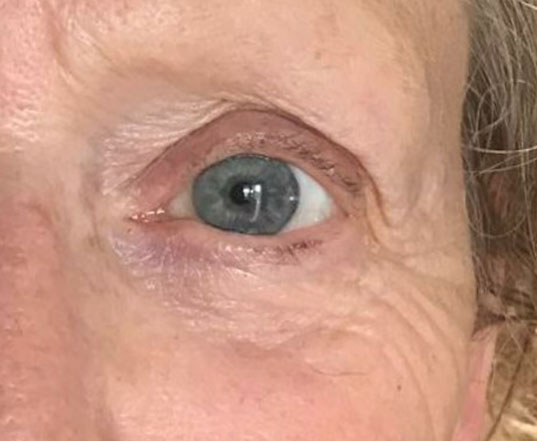 Before & After Wrinkle Treatment after image