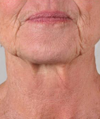 Before & After LYMA Treatment after image
