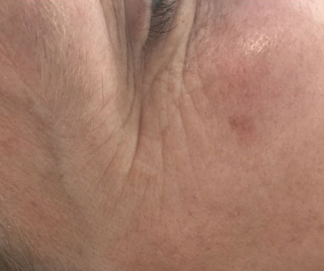 Before & After Crow's Feet Treatments before image