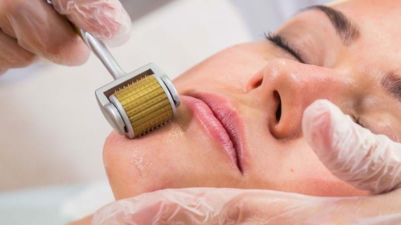 Microneedling