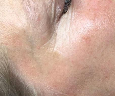 Before & After Crow's Feet Treatments after image