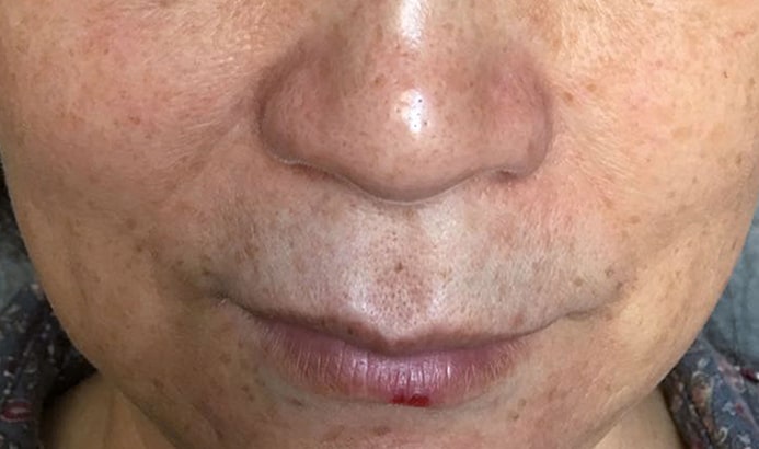 Before & After Treatment before image