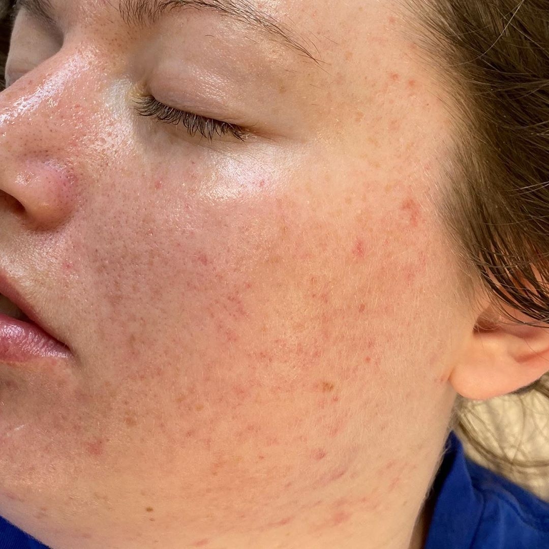 Before & After Acne Treatments after image