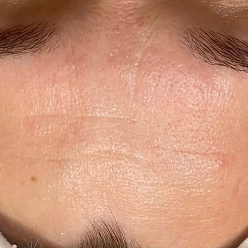 Before & After Dermalux Treatments after image