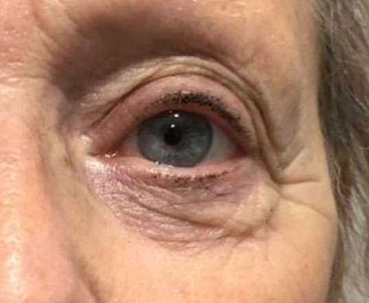 Before & After Wrinkle Treatment before image