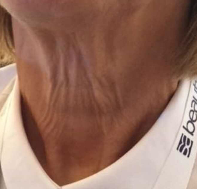 Before & After Treatment before image