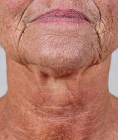 Before & After LYMA Treatment before image