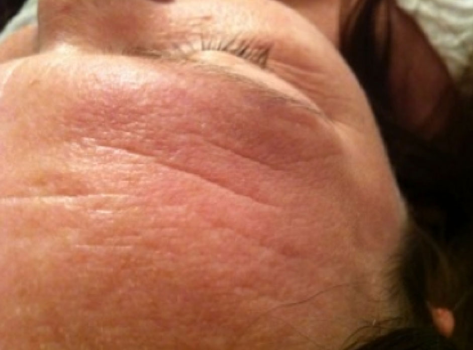 Before & After Treatment before image