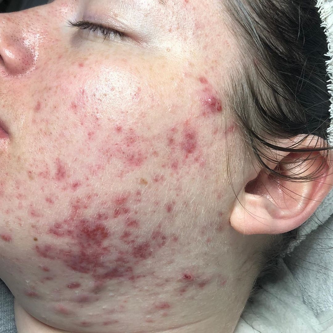 Before & After Acne Treatments before image